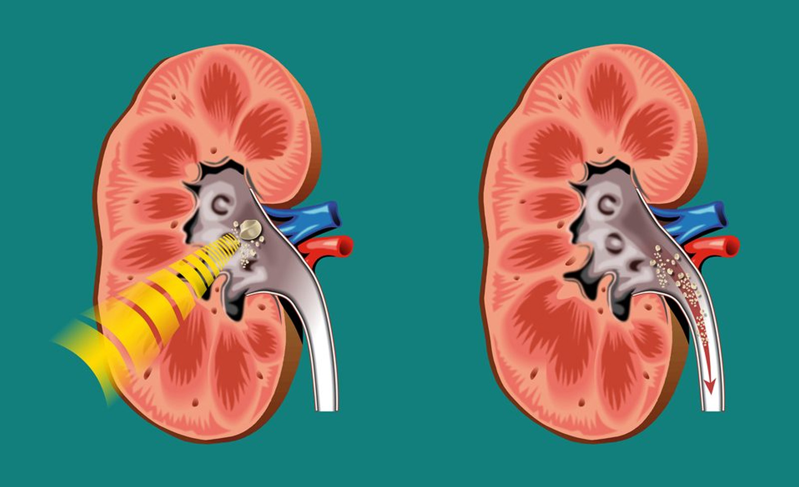 Laser Treatment for Kidney Stones: Procedure, Recovery & Success Rates